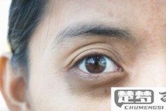 眼圈发黄是怎么回事？可能的原因和改善方法