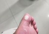 脚上磨出了水泡怎么办？快速处理与预防方法全解析