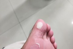 脚上磨出了水泡怎么办?快速处理与预防方法全解析