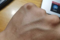 手背发黑是怎么回事？可能的原因及改善方法