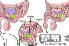 慢性前列腺炎怎么治疗？最佳治疗方法及注意事项全解析