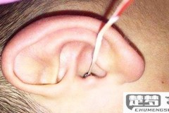 虫子进耳朵里了怎么办？紧急处理、预防与就医指南