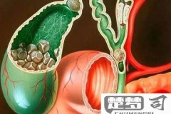 胆囊结石怎么形成的？原因、预防与治疗方法全解析