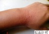 紫外线过敏怎么根治？科学治疗方法与日常护理全指南
