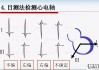 心电轴右偏怎么回事？原因、检查与治疗方法全解析