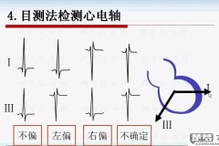 心电轴右偏怎么回事？原因、检查与治疗方法全解析