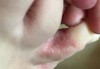 脚趾缝烂脱皮痒怎么办？有效的治疗与预防方法