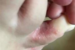 脚趾缝烂脱皮痒怎么办？有效的治疗与预防方法