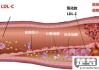 动脉硬化斑块怎么清除？医学治疗与自然方法全解析