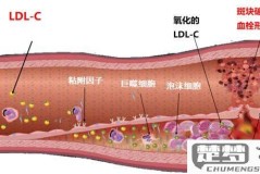 动脉硬化斑块怎么清除?医学治疗与自然方法全解析