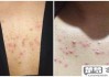 胸前长痘痘怎么消除？有效的日常护理和治疗方法