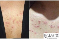 胸前长痘痘怎么消除？有效的日常护理和治疗方法