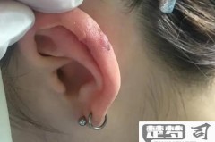 打完耳洞后怎么护理才能避免感染？