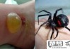 被蜘蛛咬了会怎么样？识别症状与急救措施全指南