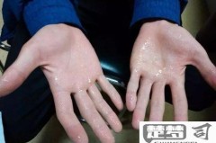 手容易出汗怎么解决？日常护理与医疗干预全指南