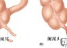 阑尾炎怎么缓解疼痛？科学应对方案与自然方法