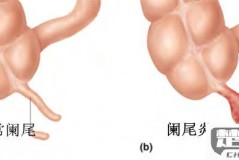 阑尾炎怎么缓解疼痛？科学应对方案与自然方法