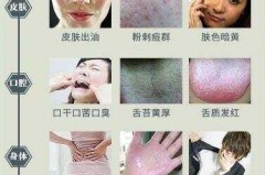 怎么判断湿气往外排出?湿气往外排出的症状有哪些?