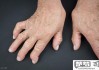 类风湿手指肿胀怎么办？综合治疗与日常护理全指南