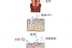 HPV是怎么引起的以及如何有效预防？