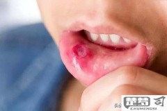 口腔里面烂了怎么办?快速止痛与预防复发全攻略