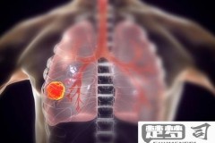 肺部有肿瘤怎么治疗？全面解析治疗方案与注意事项