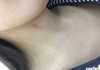 怎么鉴定是不是吻痕？专业鉴别方法与消除技巧