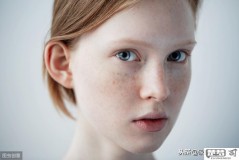 脸上有雀斑怎么去掉？科学方法与自然疗法全解析