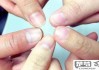 指甲竖条纹是怎么回事？可能的原因及预防方法