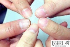 指甲竖条纹是怎么回事？可能的原因及预防方法
