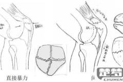 髌骨骨折怎么康复训练？分阶段详细指南