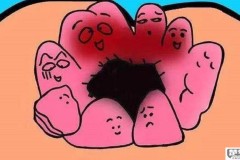痔疮外痔肉球怎么消除？有效的治疗方法与预防措施
