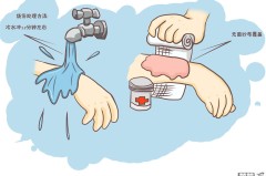 烫伤起水泡怎么处理?科学应急处理步骤全解析