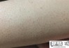 毛周角化症怎么去除？有效方法与自然疗法全解析
