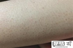 毛周角化症怎么去除？有效方法与自然疗法全解析