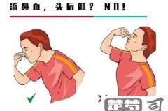 流鼻血怎么止血最快?家庭常用方法及频繁流鼻血的可能原因