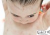 怎么确定是不是湿疹？湿疹的早期症状与最佳治疗方法全解析
