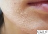 皮肤干燥起皮痒怎么办？有效的解决方案和日常护理方法