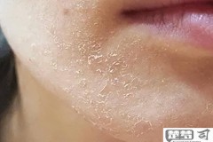 皮肤干燥起皮痒怎么办?有效的解决方案和日常护理方法