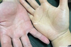 手心发黄是怎么回事？可能的原因及自然疗法改善方法