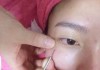 眼周脂肪粒怎么去掉？科学有效的去除方法与预防措施