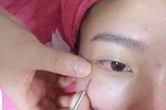 眼周脂肪粒怎么去掉?科学有效的去除方法与预防措施