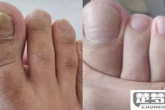 脚上有灰指甲怎么办？最有效的治疗方法与预防措施