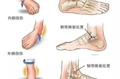 脚踝扭伤怎么快速恢复？专家推荐的恢复方案与运动指南