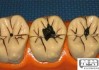 牙齿黑色污垢怎么去除？专业方法与自然疗法全解析