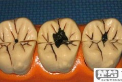 牙齿黑色污垢怎么去除？专业方法与自然疗法全解析