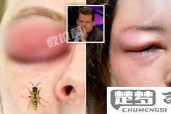 被蜜蜂蛰了会怎么样？急救措施与预防方法全解析