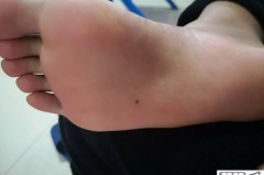 脚底长黑痣是怎么回事？需要担心吗？