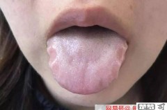舌头有齿痕怎么调理？中医推荐健脾祛湿的饮食与生活方式
