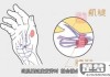 大拇指腱鞘炎怎么治疗？最佳治疗方法及自我缓解技巧